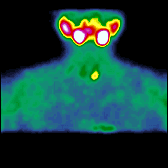 Fuzja SPECT/CT 99m Tc