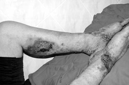 Acta Angiol., 2007, Vol. 13, No. 4 ce the patient complained about rest pain in the right lower limb, surgical treatment was necessary.