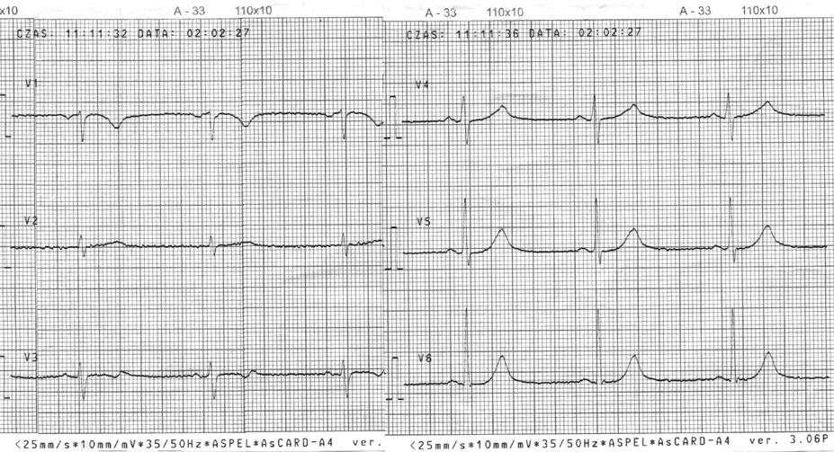 Aneta Kucharczyk-Foltyn i wsp., Submasywna zatorowość płucna Rycina 2. Zapis elektrokardiograficzny odprowadzeń przedsercowych badanie kontrolne Rycina 1.