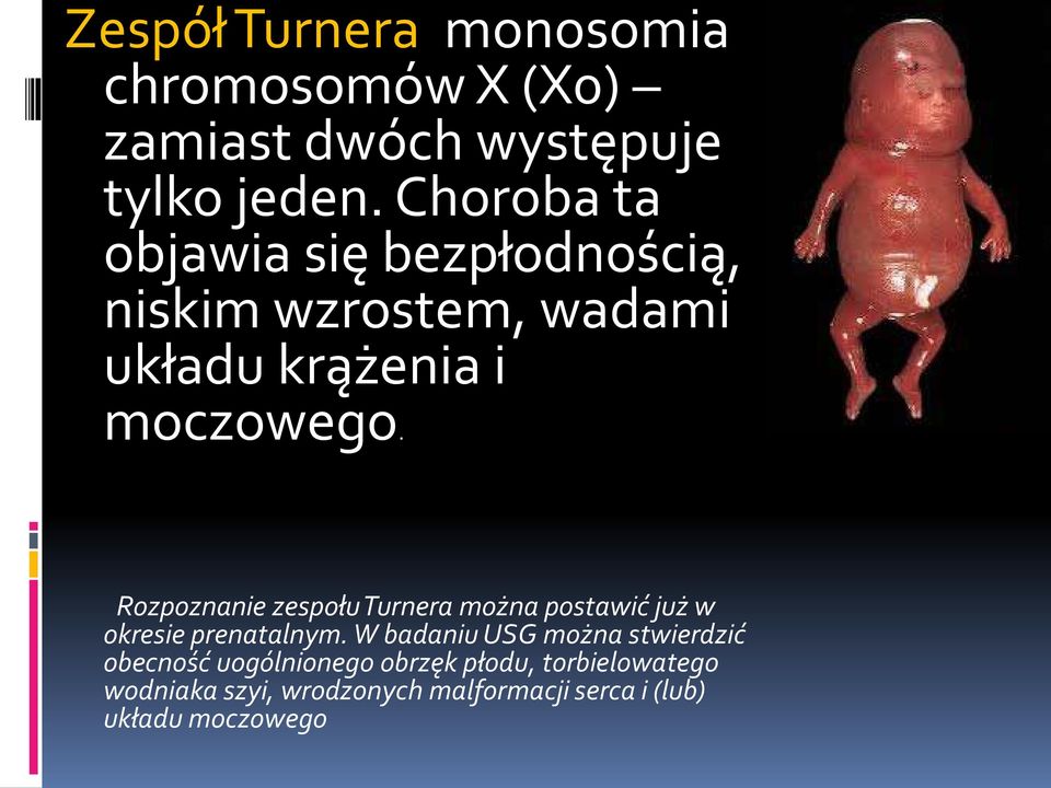 Rozpoznanie zespołu Turnera można postawić już w okresie prenatalnym.