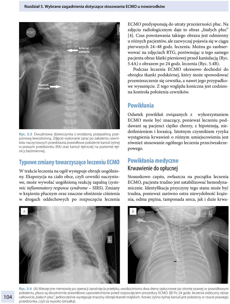 Można go zaobserwować na zdjęciach RTG, porównując u tego samego pacjenta obraz klatki piersiowej przed kaniulacją (Ryc. 5.4A) z obrazem po 24 godz. leczenia (Ryc. 5.4B).