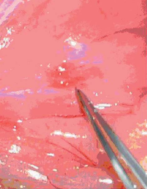Ryc. 3. Zdjęcie torbieli endometrialnej i prostej bez cech endometriozy Ryc. 4.