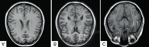 Zmiany neurochemiczne w przednim zakręcie obręczy w zaburzeniu afektywnym 841 Cel Biorąc pod uwagę powyższe doniesienia z piśmiennictwa, celem naszego badania było określenie zmian neurochemicznych