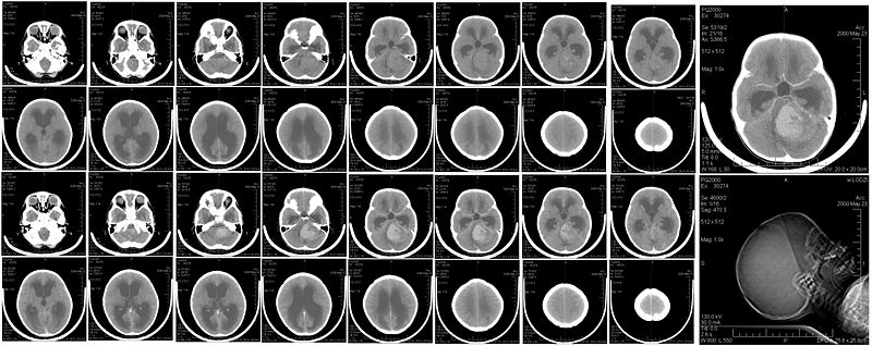 Tomografia komputerowa (CT) Jest to badanie polegające na wykonywaniu zdjęć rentgenowskich badanego narządu pacjenta w różnych