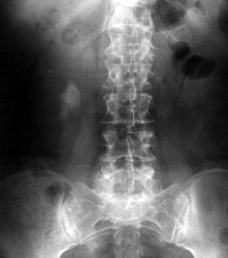 Application of the percutaneous nephrolithotomy method in the treatment of staghorn nephrolithiasis of solitary kidney Polish Surgery 2012 14, 1 2 nie ogólne moczu i posiew.