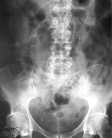 Chirurgia Polska 2012, 14, 1 2 Leczenie kamicy odlewowej nerki jedynej z wykorzystaniem przezskórnej nefrolitotrypsji Rycina 2. Urografia zdjęcie po 15 minutach Figure 2.