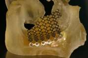 WSPÓŁPRACA Z PRZEMYSŁEM e wzorca tekstu IMPLANTY MEDYCZNE 3D 3D RECONSTRUCTION VIRTUAL MODEL BIOMODEL IMPLANT (TITANIUM MESH 0,4 MM) ODKODUJ