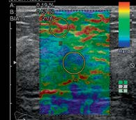 The differentiation of the character of solid lesions in the breast in the compression sonoelastography. Part II: Diagnostic value of BIRADS-US classification, Tsukuba score and FLR ratio Ryc. 1.