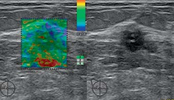 The differentiation of the character of solid lesions in the breast in the compression sonoelastography.