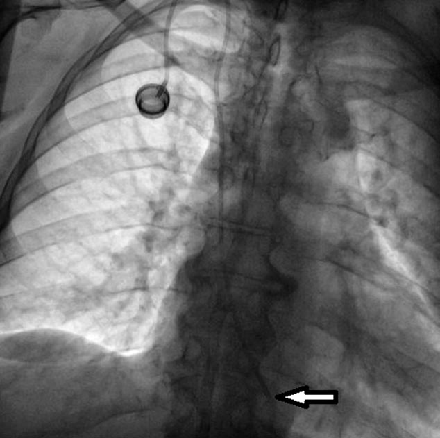 Wstęp Centralne cewniki żylne (CVC, central venous catheters) są najczęściej wykorzystywane u pacjentów onkologicznych, przede wszystkim do podawania chemioterapii.