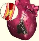 Etiologia HF!