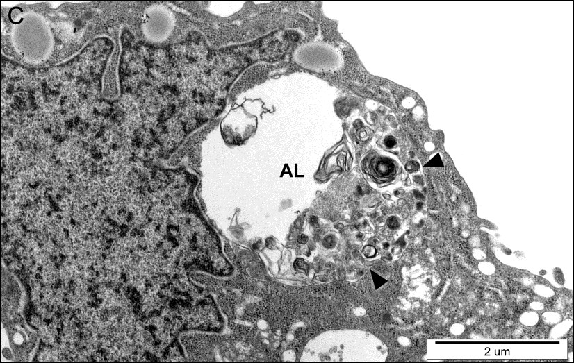WYNIKI Ryc. 14 Różne etapy formowania wakuol autofagowych w komórkach PC-3 traktowanych werapamilem (100 µm; A 6 godz., B 12 godz., C 24 godz.).