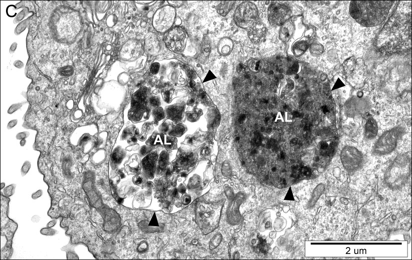 WYNIKI Ryc. 15 Różne etapy formowania wakuol autofagowych w komórkach PNT-2 traktowanych werapamilem (100 µm, 24 h).