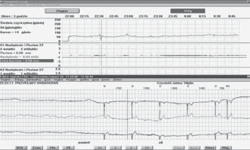 150 Dorota Zyśko et al. Figure 1. A representative ECG strip from a VP( )/JR(+) group patient. Junctional rhythm during neurocardiogenic reaction provoked by tilt testing Figure 2.