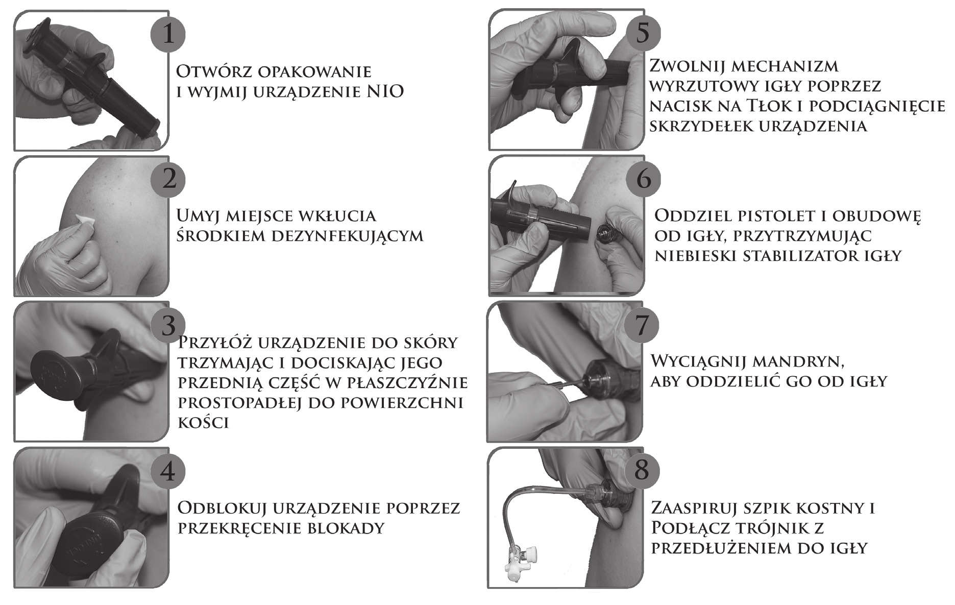 Rycina 4. Procedura wykonania dostępu doszpikowego za pomocą NIO Adult Figure 4.