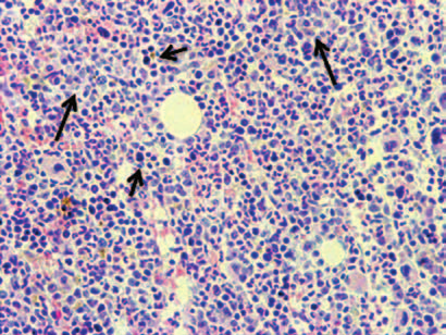 Hematologia 2010, tom 1, nr 3 A A. Wzrost odsetka monocytów we krwi obwodowej (zaznaczono strzałkami) (barwienie metodą Maya-Grünwalda-Giemsy, 500) B B.