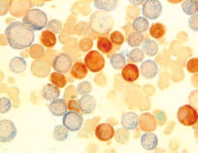 Komórki monoidalne (brązowe) i granulocyty (niebieskie ziarnistości) w rozmazie szpiku (barwienie esterazą nieswoistą, 1000) D D.