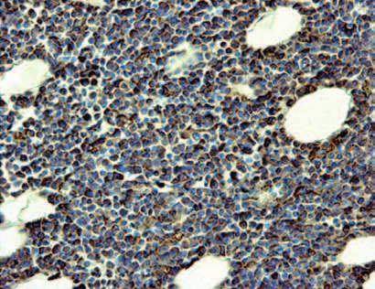 Rycina 1. Przewlekła białaczka mielomonocytowa typ mieloproliferacyjny Figure 1.
