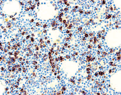 Atypical chronic myelomonocytic leukemia w lewo, z obecnością blastów, promielocytów, mielocytów, które stanowią 10 20% WBC krwi obwodowej.