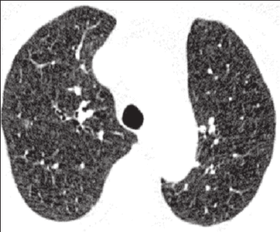 Pneumonologia i Alergologia Polska 2009, tom 77, nr 1, strony 23 30 A B C D Rycina 1. Badanie TKWR klatki piersiowej u chorych z IPAH (A C).