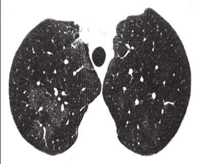 zakrzepowo-zatorowym perfuzja mozaikowa (D) Figure 1. Chest HRCT images from patients with IPAH (A C). Patchy (A) and perihilar (B) ground glass opacifications. Centrilobular nodules (C).