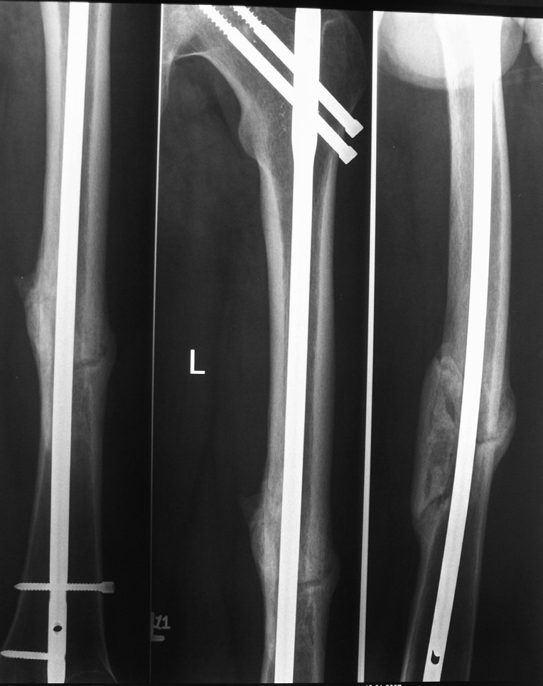 Peł ny zrost kost - ny, pozwalający na chodzenie bez pomocy kul, uzyskaliśmy po siedmiu miesiącach (Ryc. 3a, 3b). A becular bone. Injury to both lower limbs prolonged the rehabilitation period.