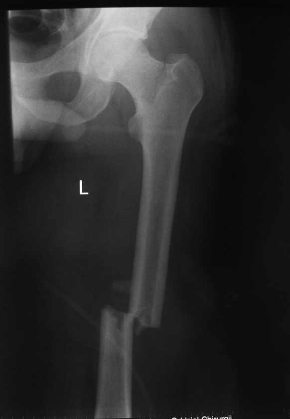 Pacjent B. A. lat 31. Doznał po upadku z wysokości kilkunastu metrów złamania trzonów obu kości udowych oraz nie przemieszczonego złamania szyjki lewej kości udowej.