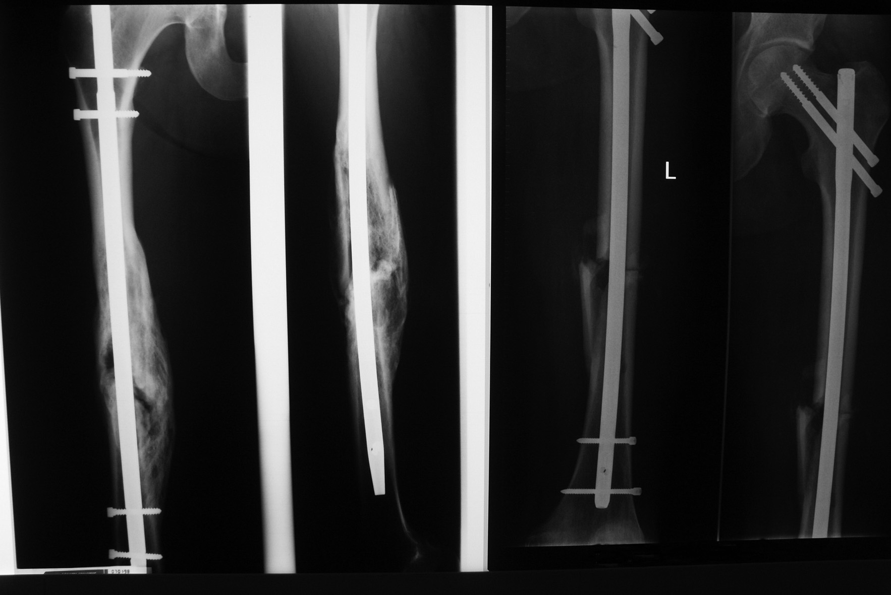 Izolowane złamanie trzonu lewej kości udowej zespoliliśmy sposobem zamkniętym gwoździem śródszpikowym ryglowanym statycznie, a złamanie szyjki i trzonu po A Wójcik K.