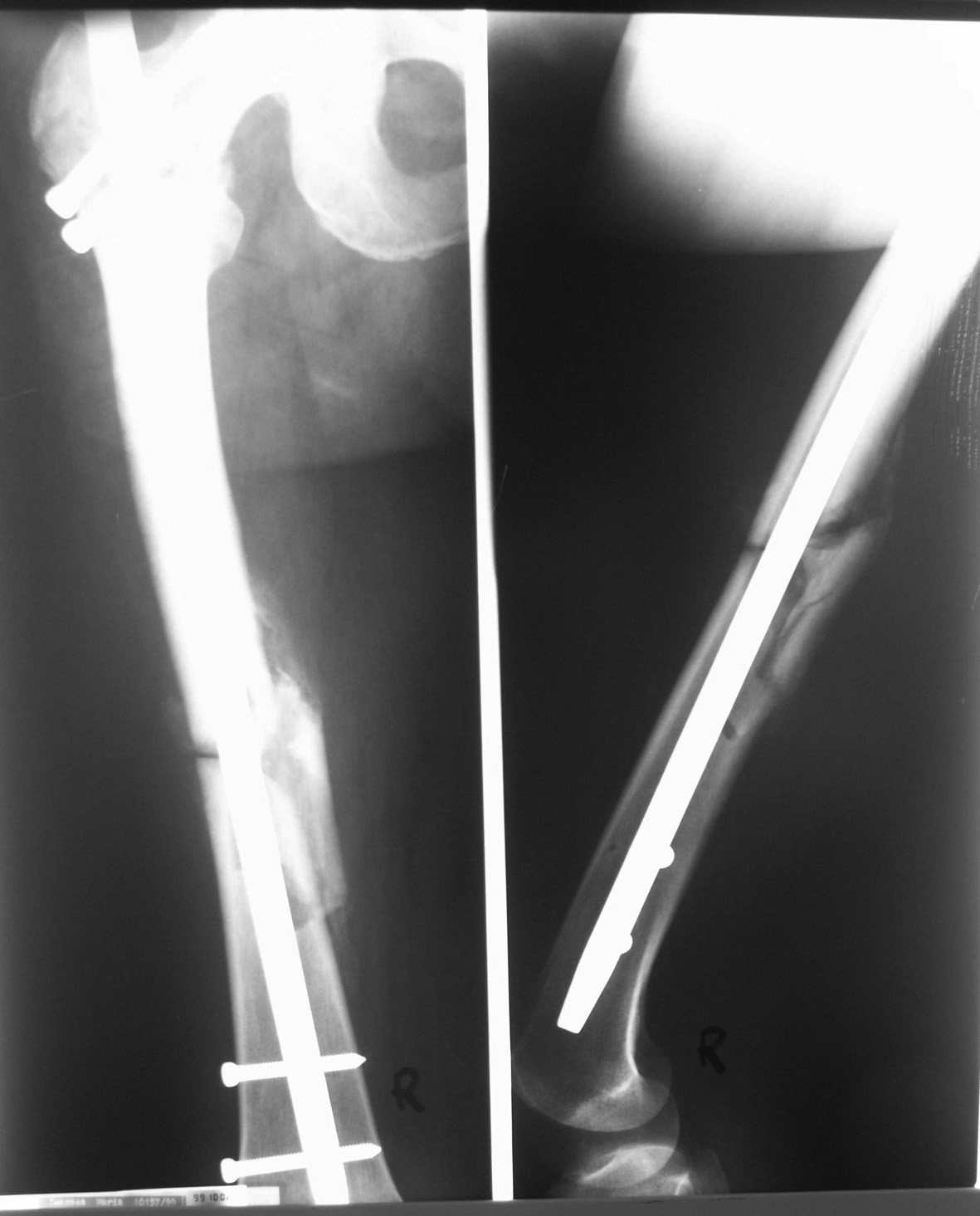 The isolated left femoral shaft fracture was stabilised using closed locked intra me - dullary nailing and the right femoral neck and shaft fracture was fixed with a reconstruction nail.