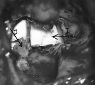 CHRONIC OTITIS MEDIA evaluate the effectiveness of pharyngeal muscle kinesiotherapy. mobile fragments. We carefully formed the front corner.