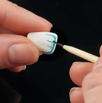 Całkowicie anatomiczna Indywidualna korona na ząb przedni Przykładowe wykonanie ceramill