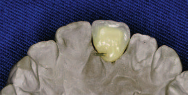 Jeżeli jej zakończenie byłoby regularne, powstałoby nienaturalne odcięcie tej warstwy. Zakończenie dentyny musi tworzyć układ odpowiadający strukturze palczastej zębiny (mamelonom).
