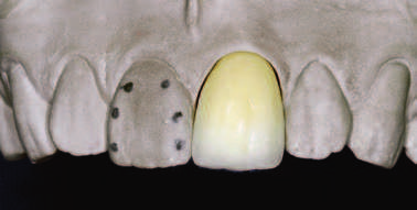 Również i tę warstwę nakłada się okrężnie, a jej zakończenie w obszarze brzegu siecznego powinno odpowiadać mamelonom, podobnie jak w przypadku dentyny nieprzeziernej (fot. 37).