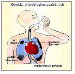 Dziennik Urzędowy Województwa Łódzkiego 27 Poz. 5553 Zdjęcie 13. Ogniska chorób azbestozależnych. Pylica azbestowa (azbestoza) to rodzaj pylicy płuc spowodowanej wdychaniem włókien azbestowych.