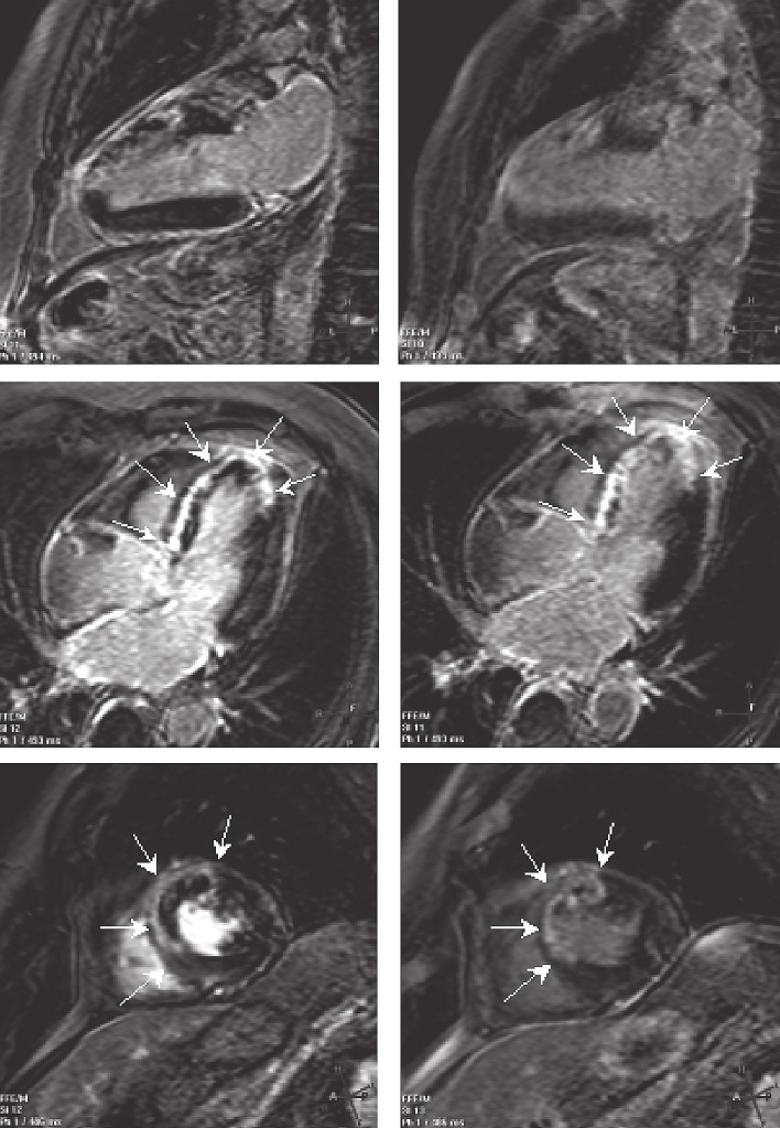 Ostry zawał serca w obrazowaniu metodą rezonansu magnetycznego S 445 Panel A Panel B I II III Rycina 3.