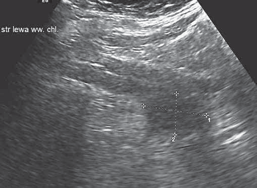 Obraz w ultrasonografii przezpochwowej wczesnego raka jajnika. Rycina 4.