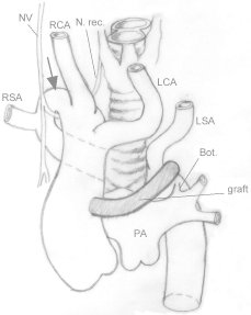 Szyjny ³uk aorty 377 a) b) Ryc. 6. Schematycznie uwidoczniona konfiguracja naczyñ u tego samego dziecka; a) odpowiadaj¹ca angiografii z ryc. 5 projekcja A-P; b) projekcja boczna. Bot.