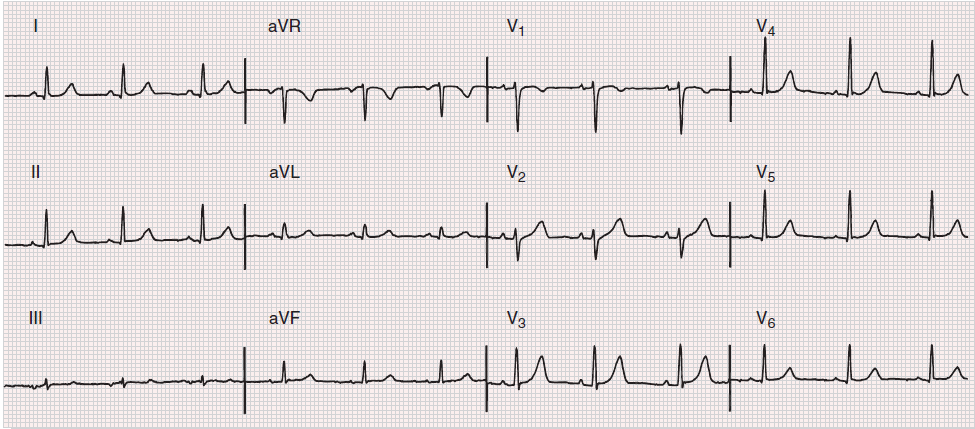 Interpretacja EKG - kroki 1. Rytm - przynajmniej 3 ewolucje: - ocena pochodzenia (gdy jest zatokowy załamek P jest dodatni w I, II, oraz ujemny w avr) - ocena częstośći 2.