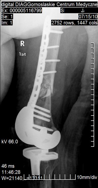 endoprotezoplastyka 07.