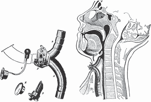 18 Otorynolaryngologia, 2006, 5(1), 17-23 pracuj¹cy w Wiedniu opisa³ w 1859 r.