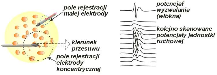 Scanning EMG Jeśli zamiast igły dwuelektrodowej użyje się elektrody koncentrycznej, niezależnej od elektrody zapisującej potencjał włókna, można zrealizować badanie metodą Scanning EMG.