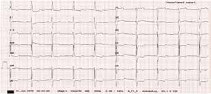Folia Cardiologica 2014, tom 9, nr 1 W badaniu echokardiograficznym uwidoczniono cechy łagodnej dysfunkcji skurczowej mięśnia lewej komory z frakcją wyrzutową lewej komory (LVEF, left ventricle