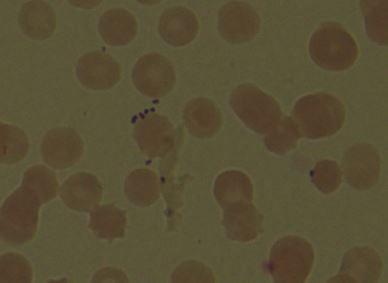 Zdjęcie 1 i 2. Rozmaz kropli krwi barwiony metodą Grama - ziarenkowce Gram-dodatnie (S. pneumoniae). Zdjęcie 3 i 4. Rozmaz kropli krwi barwiony metodą Grama - ziarenkowce Gram-dodatnie (S. aureus).