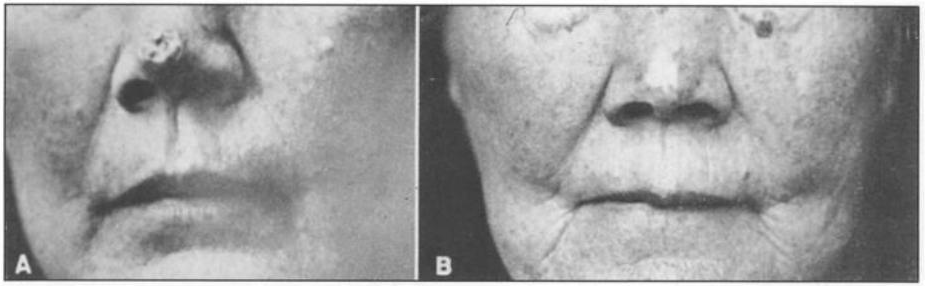 Radioterapia Początki 1895: odkrycie promieni X przez Wilhelma Röntgena 1895: pierwsza próba wykorzystania terapeutycznego (Chicago) 1899: pierwszy