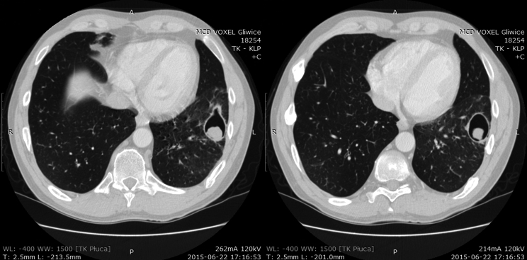 Pneumonol Alergol Pol 2016; 84, supl. 4: 16 21 Rycina 2.