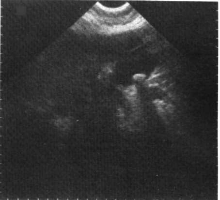 W diagnostyce ultrasonograficznej całkowite wewnętrzne odbicie występuje często na granicy kamienie nerkowe miąższ nerek i stanowi istotny element interpretacji obrazu USG.