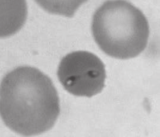 Journal of Transfusion Medicine 2011, tom 4, nr 1 Rycina 3. Babesia EU1 w krwince czerwonej człowieka [75] Figure 3.