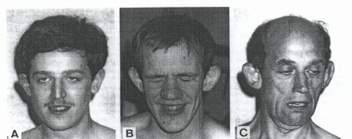 Fra X (Fragile X syndrome FraX) - 1943 r. Martin & Bell - Choroba sprzężona z chromosomem X, wykazuje semi-dominujący typ dziedziczenia, dotyczy zarówno kobiet jak i mężczyzn.