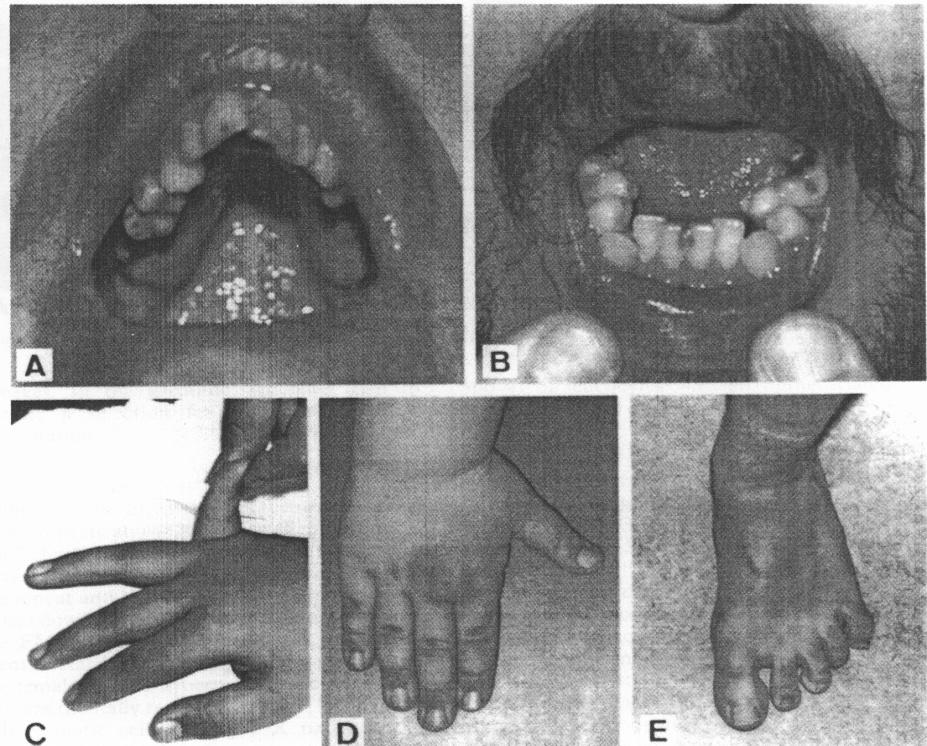 Zespół kruchego chromosomu X (Fragile X syndrome FraX) Objawy FraX Niepełnosprawnośd intelektualna głębszego stopnia 80%, u 20% chorych 70-80 IQ (pogranicze normy) Cechy fenotypowe: makroorchidyzm,