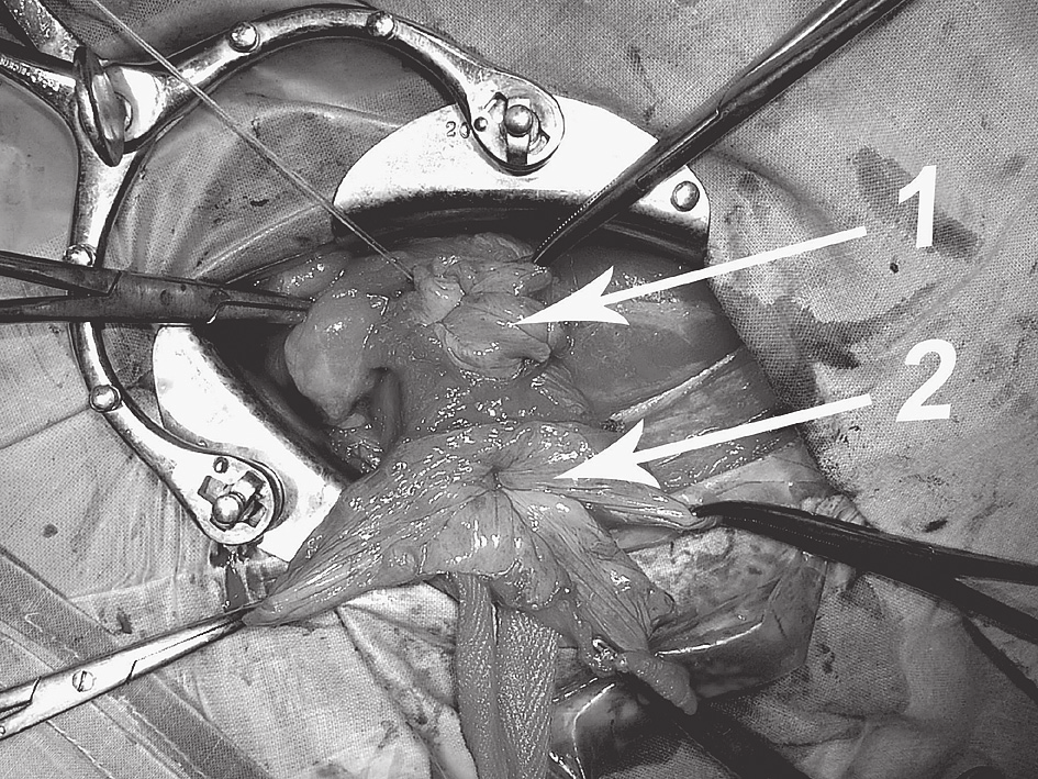 Roman Kuśnierczyk, Adam Wójcik Results of surgical treatment of large scrotal hernias Polish Surgery 2005, 7, 1 wnętrznego brzucha, od obu jego odnóg, równocześnie uwidaczniano pierścień pachwinowy